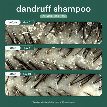 Verb Dandruff Shampoo clinical scalp results shown before use and after 1 and 21 days